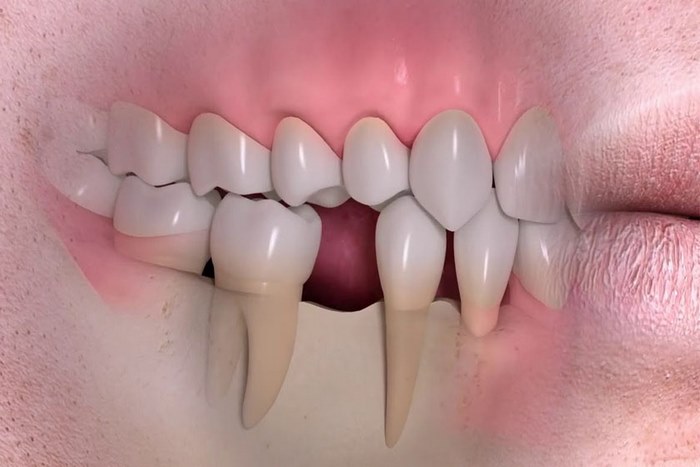 Отсутствие зуба – серьезная проблема не только эстетического характера